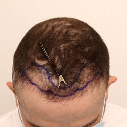 Hair Transplant - Male: Frontal FUE - Case 29 - Before FUE hair transplant