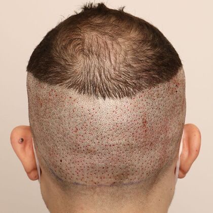 Hair Transplant - Male: Frontal FUE - Case 29 - Post-op manual FUE