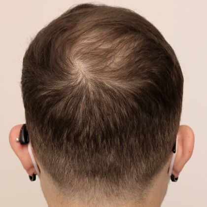 Hair Transplant - Male: Frontal FUE - Case 29 - After manual FUE 