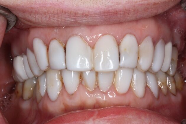 Porcelain Crowns and Veneers: Case 9 - Before