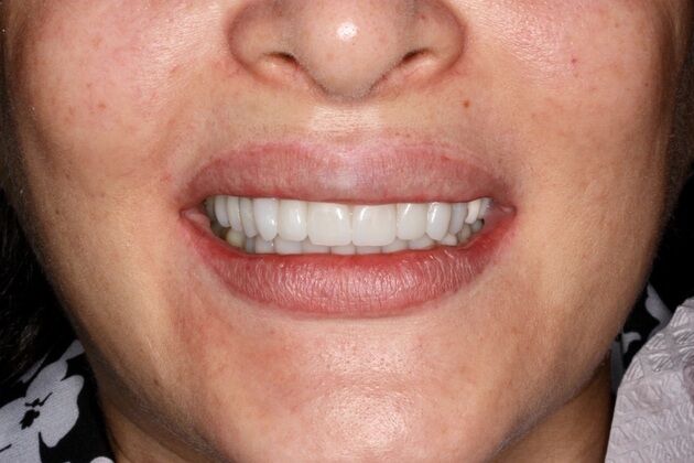 Porcelain Crowns and Veneers: Case 9 - After