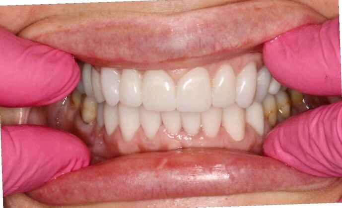 Porcelain Crowns and Veneers: Case 9 - After