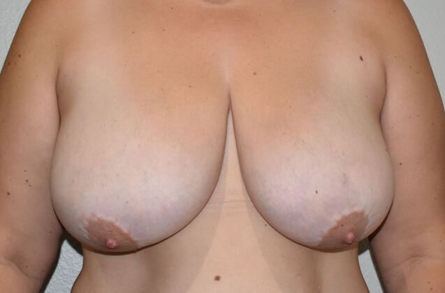 Breast Lift (Mastopexy) Case 146 - Before