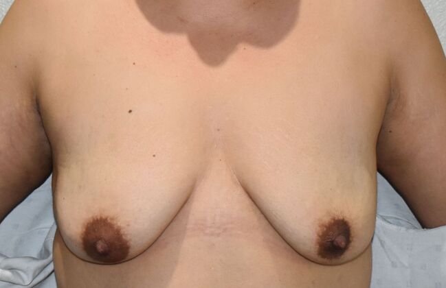 Breast Augmentation w/ Lift: Case 440 - Before