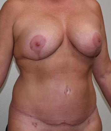 Mommy Makeover: Case 312 - After