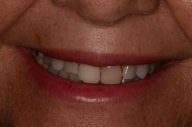 Porcelain Veneers: Case 31 - Before