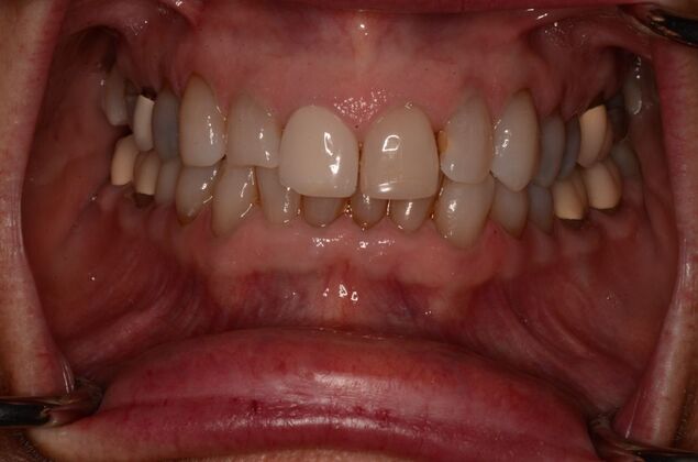 Porcelain Veneers: Case 31 - Before