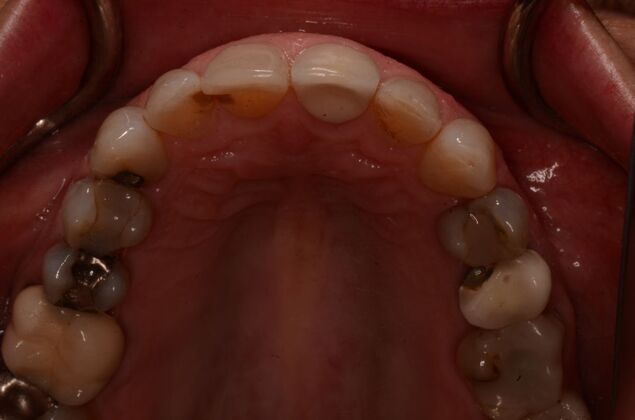 Porcelain Veneers: Case 31 - Before