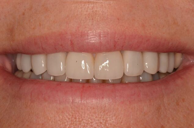 Porcelain Veneers: Case 31 - After