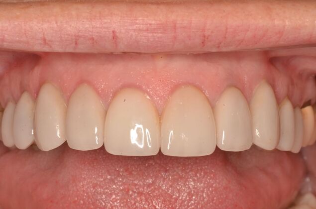 Porcelain Veneers: Case 31 - After