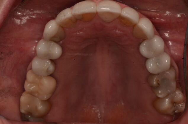 Porcelain Veneers: Case 31 - After