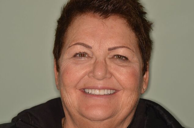 Porcelain Veneers Case 31 - After