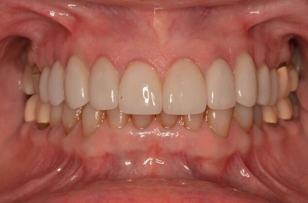 Porcelain Veneers: Case 31 - After