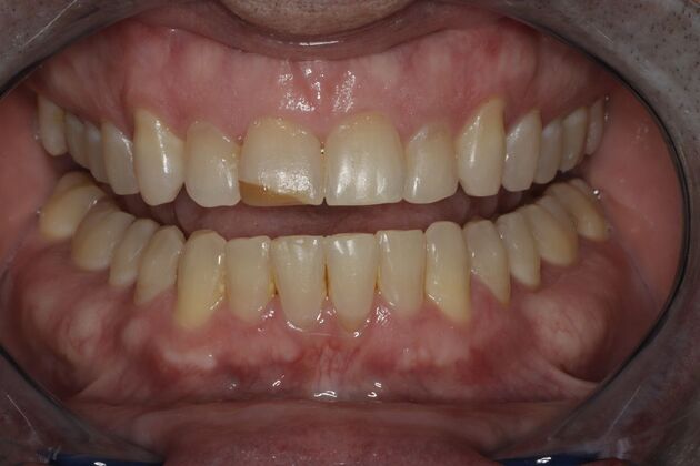 Composite Bonding: Case 8 - Before