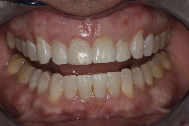 Composite Bonding: Case 8 - After