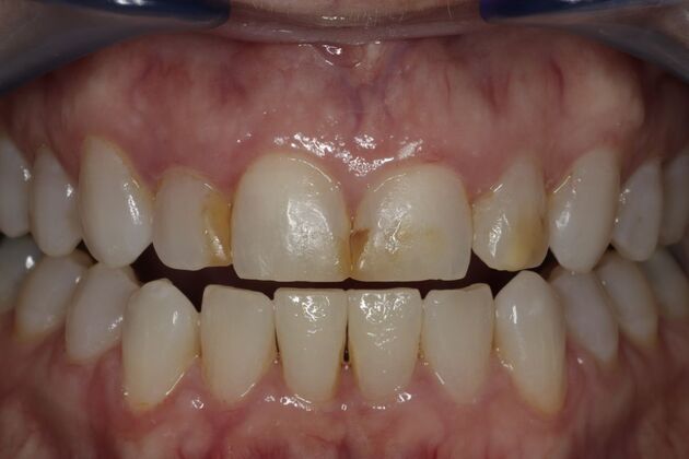 Composite Bonding Case 9 - Before
