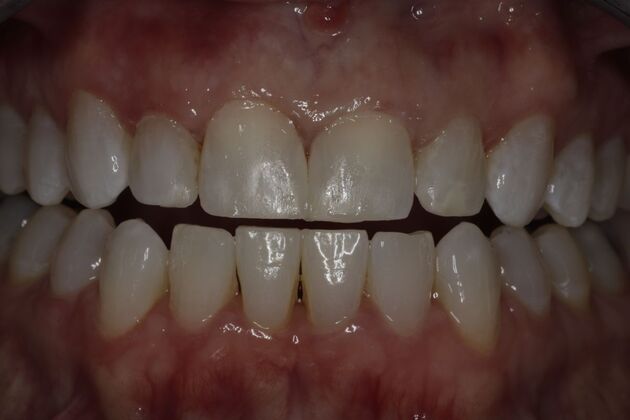 Composite Bonding Case 9 - After
