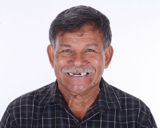 Our Results: UPPER ALL ON 6 TEETH IN A DAY - Before surgery