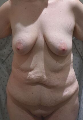 Massive Weight Loss : Case 106 - Before