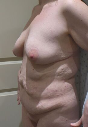 Massive Weight Loss : Case 106 - Before