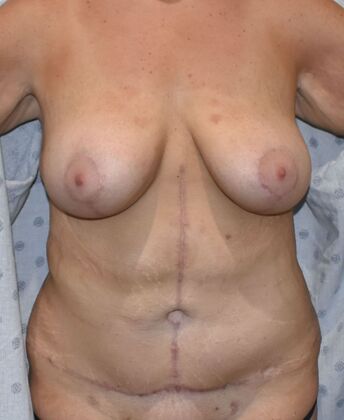 Massive Weight Loss : Case 106 - After