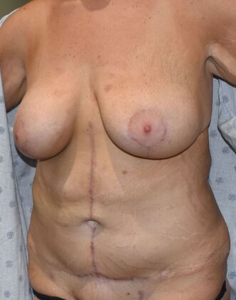 Massive Weight Loss : Case 106 - After