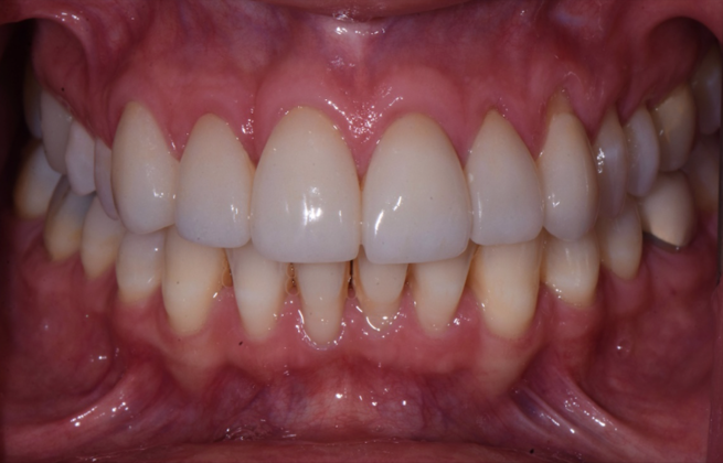 Cosmetic Crowns: Case 8 - After