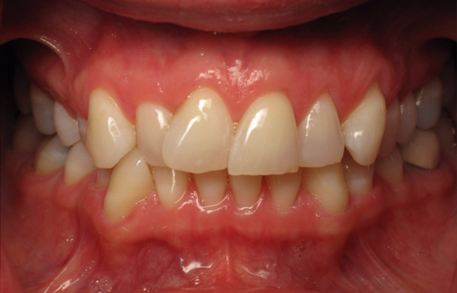 Cosmetic Crowns: Case 8 - Before