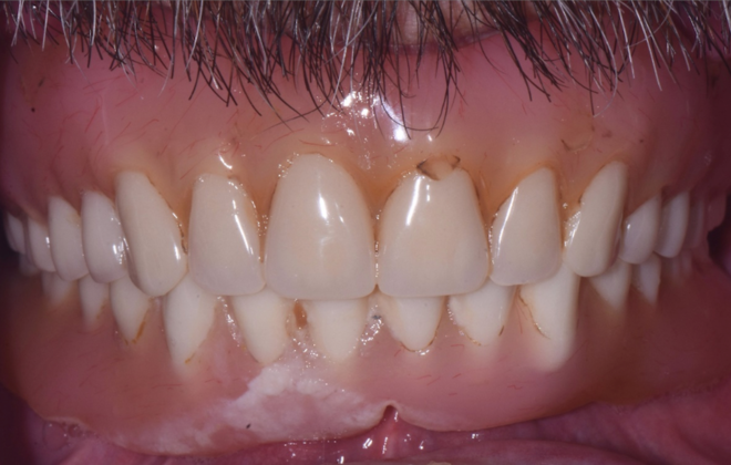 Traditional Dentures Case 4 - Before