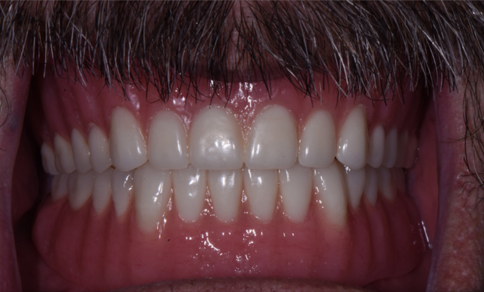 Traditional Dentures Case 4 - After