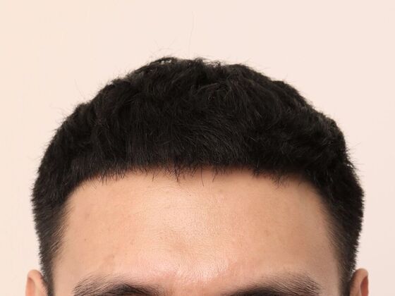 Male Before And After Hair Transplant Photos Hairline FUE (16) - After