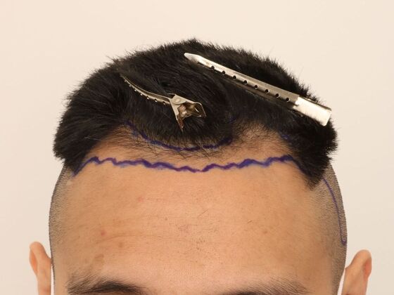 Male Before And After Hair Transplant Photos Hairline FUE (16) - Before