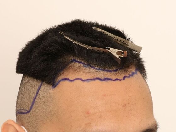 Hair Transplant - Male: Hairline FUE - Case 16 - Before FUE hair transplant