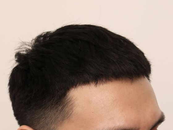 Hair Transplant - Male: Hairline FUE - Case 16 - After FUE hair transplant