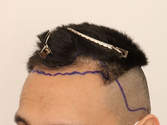 Hair Transplant - Male: Hairline FUE - Case 16 - Before FUE hair transplant