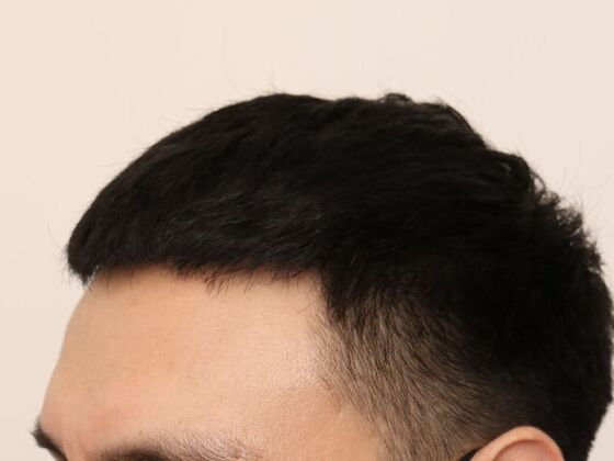 Hair Transplant - Male: Hairline FUE - Case 16 - After FUE hair transplant