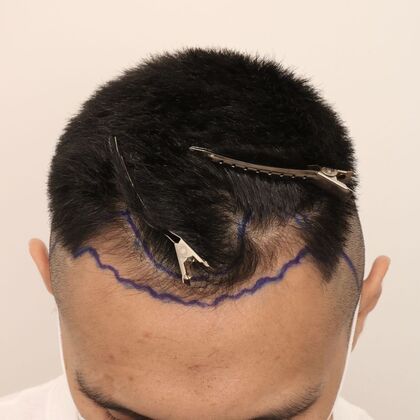 Hair Transplant - Male: Hairline FUE - Case 16 - Before FUE hair transplant
