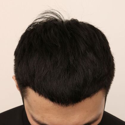 Hair Transplant - Male: Hairline FUE - Case 16 - After FUE hair transplant