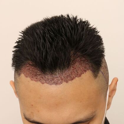 Hair Transplant - Male: Hairline FUE - Case 16 - Post-op FUE hair transplant