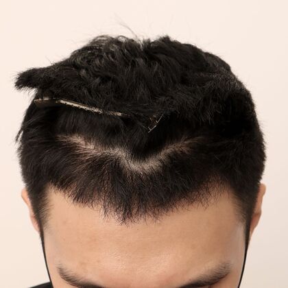 Hair Transplant - Male: Hairline FUE - Case 16 - After FUE hair transplant