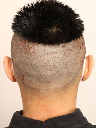 Hair Transplant - Male: Hairline FUE - Case 16 - Donor area post-op FUE hair transplant