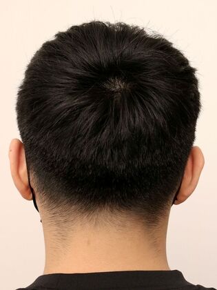 Hair Transplant - Male: Hairline FUE - Case 16 - Donor area after FUE hair transplant