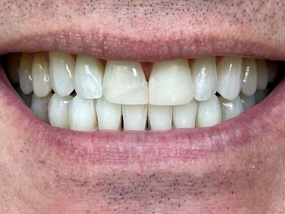 Porcelain Veneers Case 7 - Before