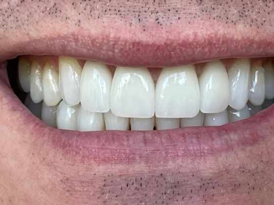 Porcelain Veneers Case 7 - After