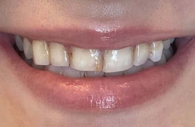 Smile Makeovers: Case 4 - Before