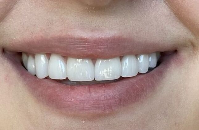 Smile Makeovers: Case 4 - After