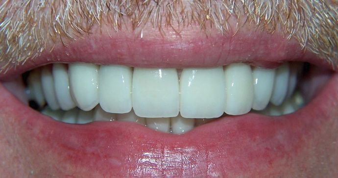 Full Mouth Reconstruction: Raimond K. - After