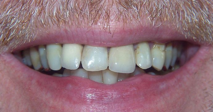 Full Mouth Reconstruction: Raimond K. - Before