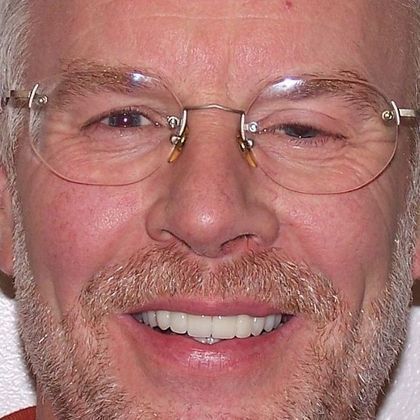 Full Mouth Reconstruction: Raimond K. - After