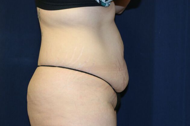Tummy Tuck*: Case 2 - Before